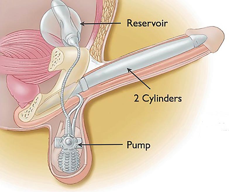 Three piece penile-implant illustration.jpg
